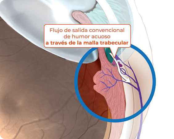 Trabecular outflow (Conventional pathway) graphic