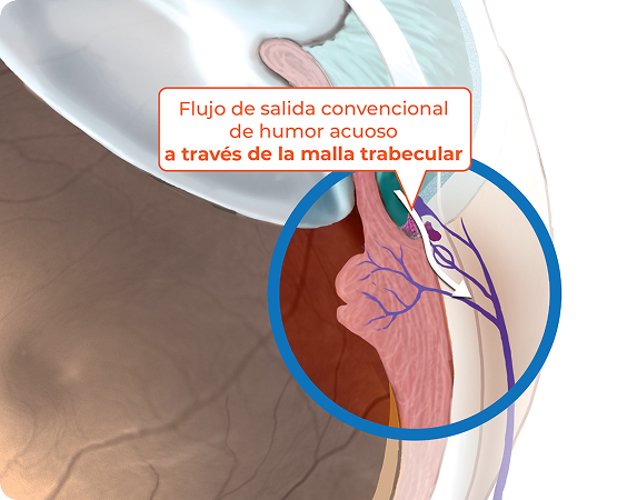 Trabecular outflow (Conventional pathway) graphic
